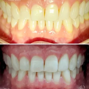 Blanqueamiento Dental